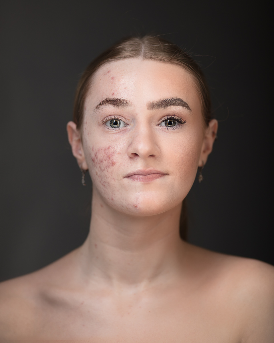 Woman with half face acne, neutral expression.